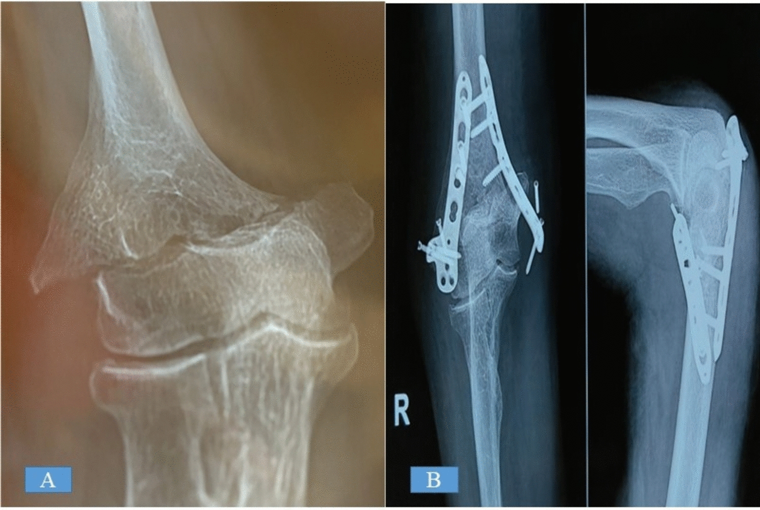 Management of Elderly Elbow Fractures