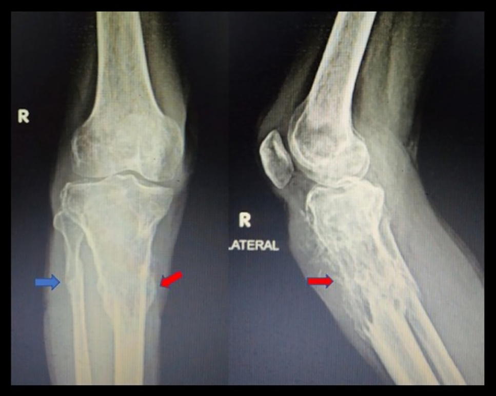 Primary Intra-osseous Malignant Peripheral Nerve Sheath Tumor of Tibia: A Case Report and Review of Literature