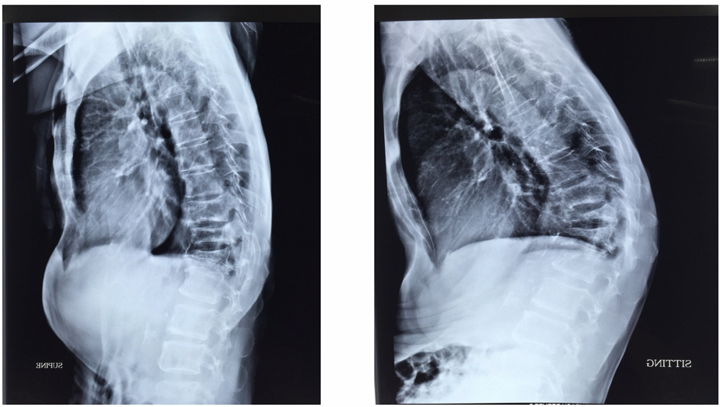 Surgical Considerations in Osteoporotic Dorso-Lumbar Spine Fractures