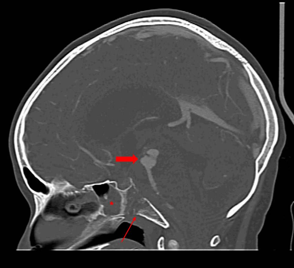 Contemporary Management of Pediatric Invasive Fungal Rhinosinusitis