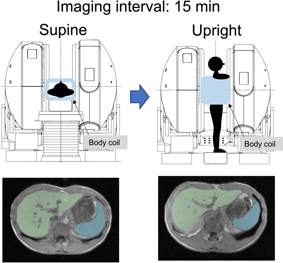 Evaluation of gravity effect on liver and spleen volumes using multiposture MRI