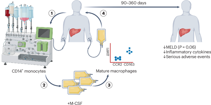 Not the end of the road for macrophage therapy in liver cirrhosis