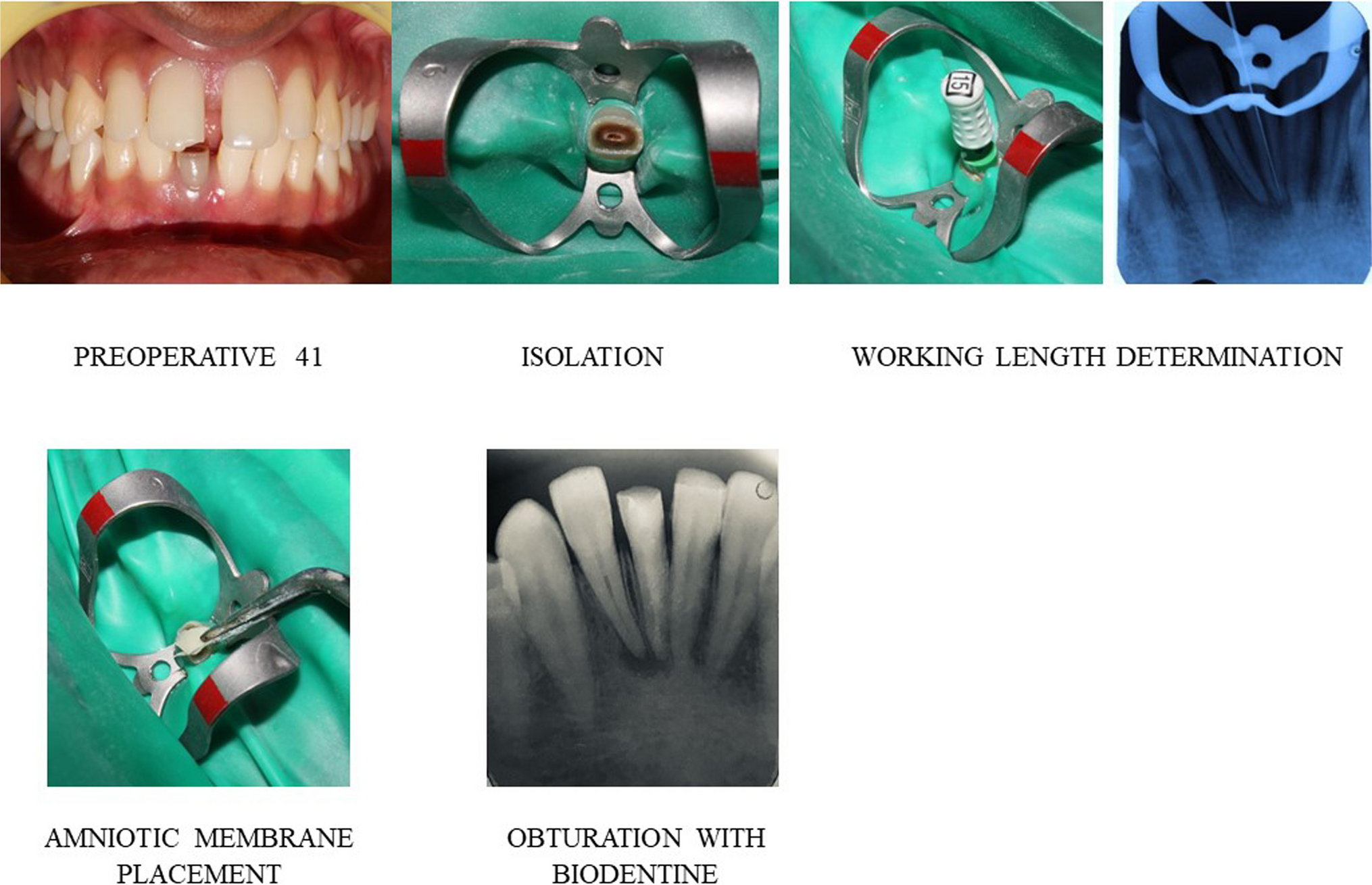 Novel Apexification Procedure as a Biotic Treatment Approach Using Amniotic Membrane Matrix and Biodentin Obturation for Immature Permanent Teeth: Case Series with Review of Literature