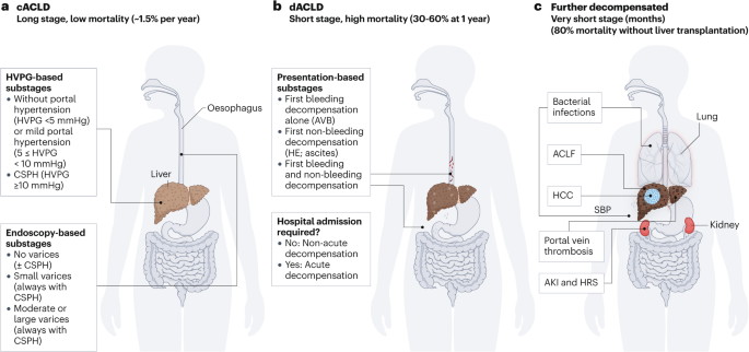 Preventing the progression of cirrhosis to decompensation and death