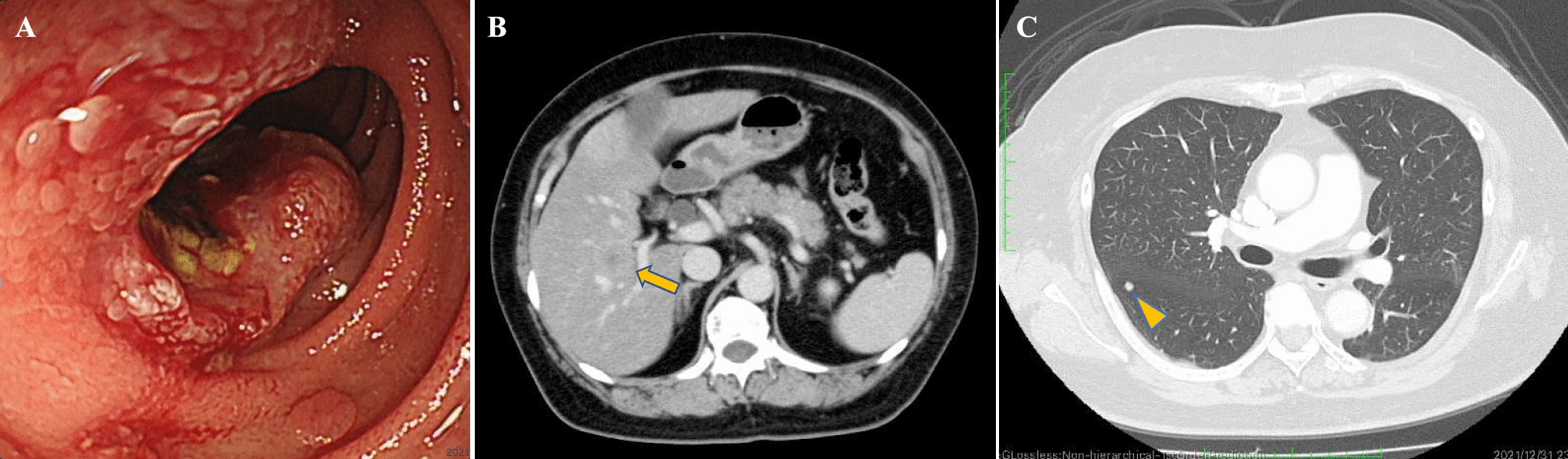 Exceptional response to brigatinib following alectinib failure in a patient with ALK fusion-positive duodenal carcinoma
