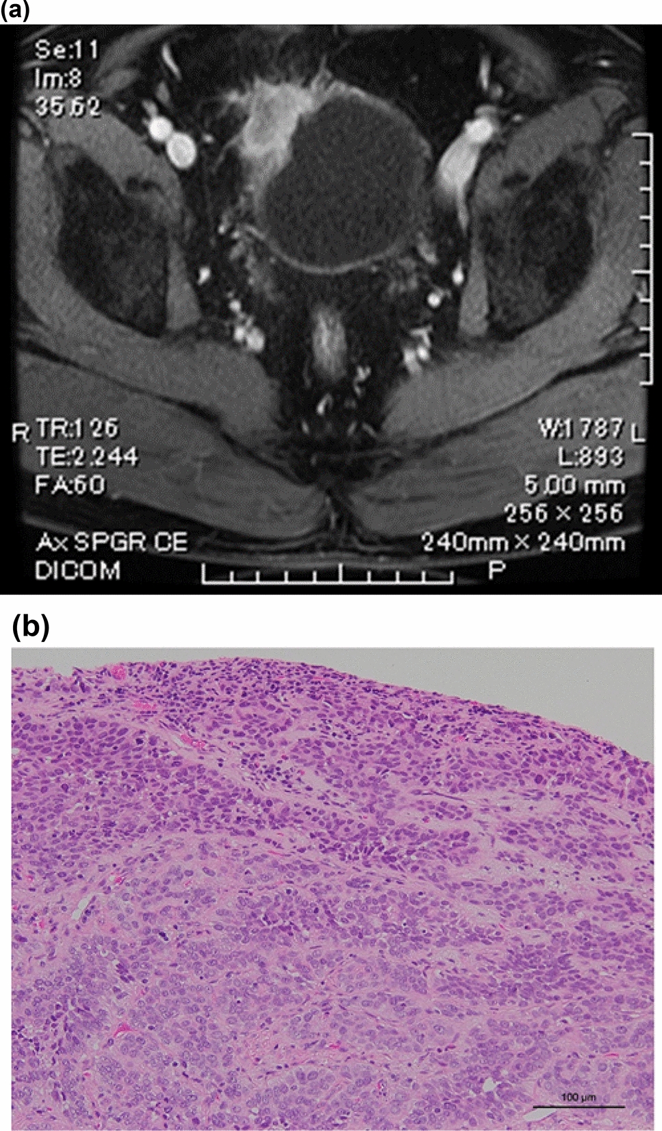 Cisplatin-induced therapy-related myelodysplastic syndrome during avelumab maintenance therapy for metastatic urothelial carcinoma