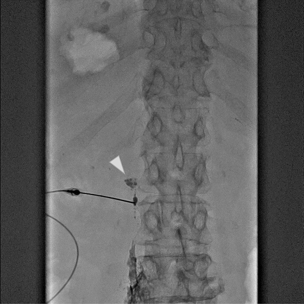 Long-term conservative treatment of chylous ascites in gynecological malignant surgery: a case report and literature review