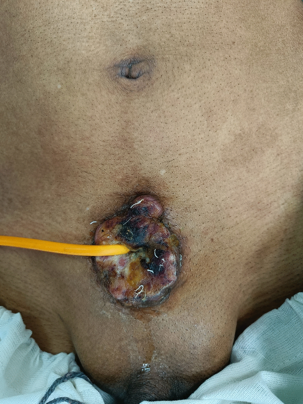 Squamous cell carcinoma in a long-standing suprapubic cystostomy: a urological oddball