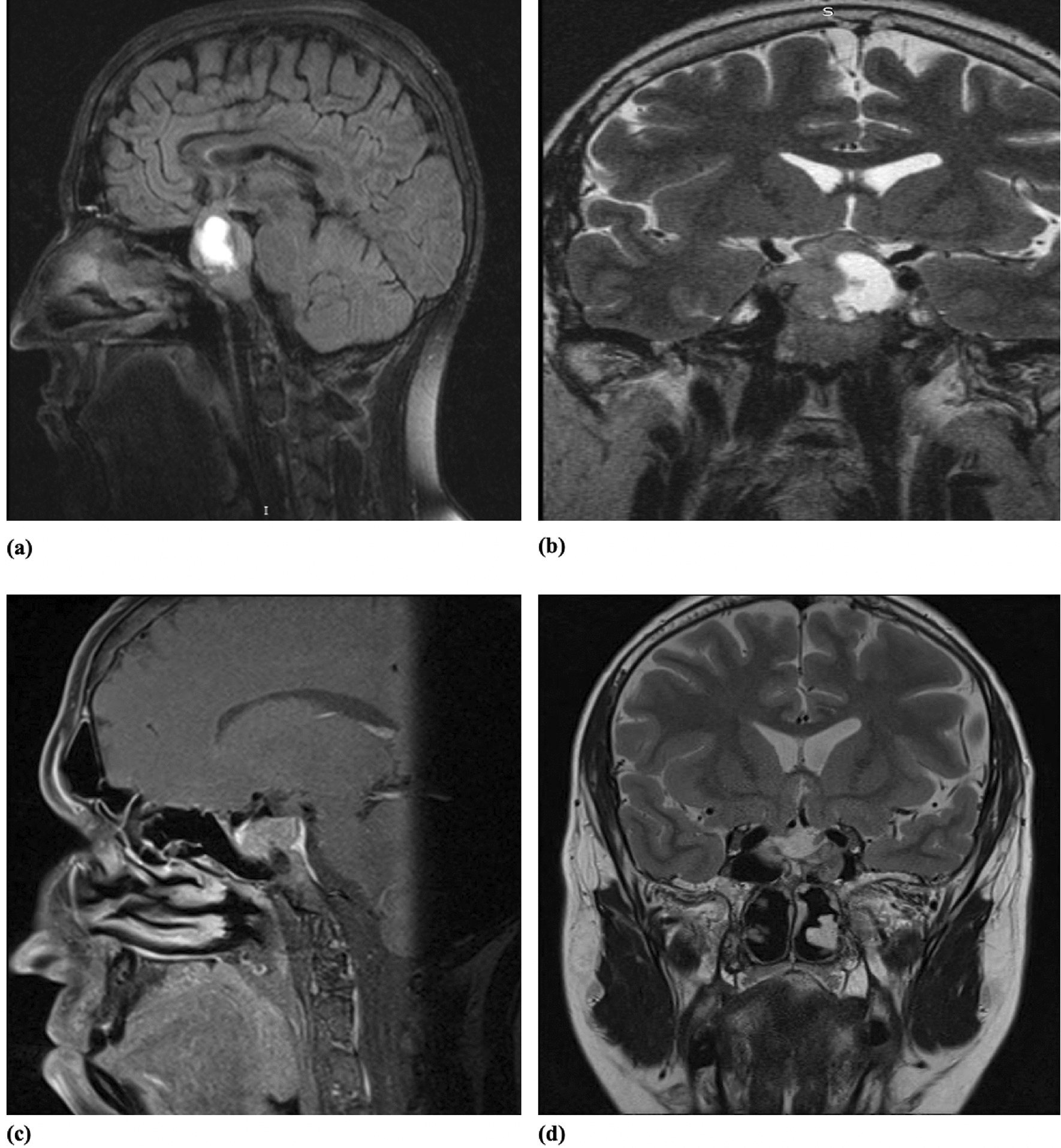 Resistant PRL-secreting PitNET associated with breast carcinoma: a case report and literature review