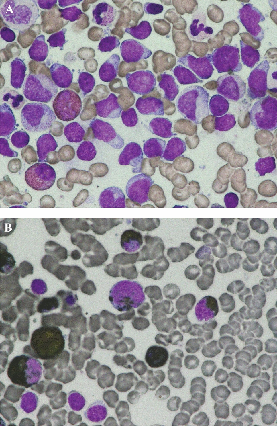 Ponatinib and prednisolone induce sustained remission in a relapsed case of mixed-phenotype acute leukemia with BCR::ABL1 fusion intolerant to dasatinib