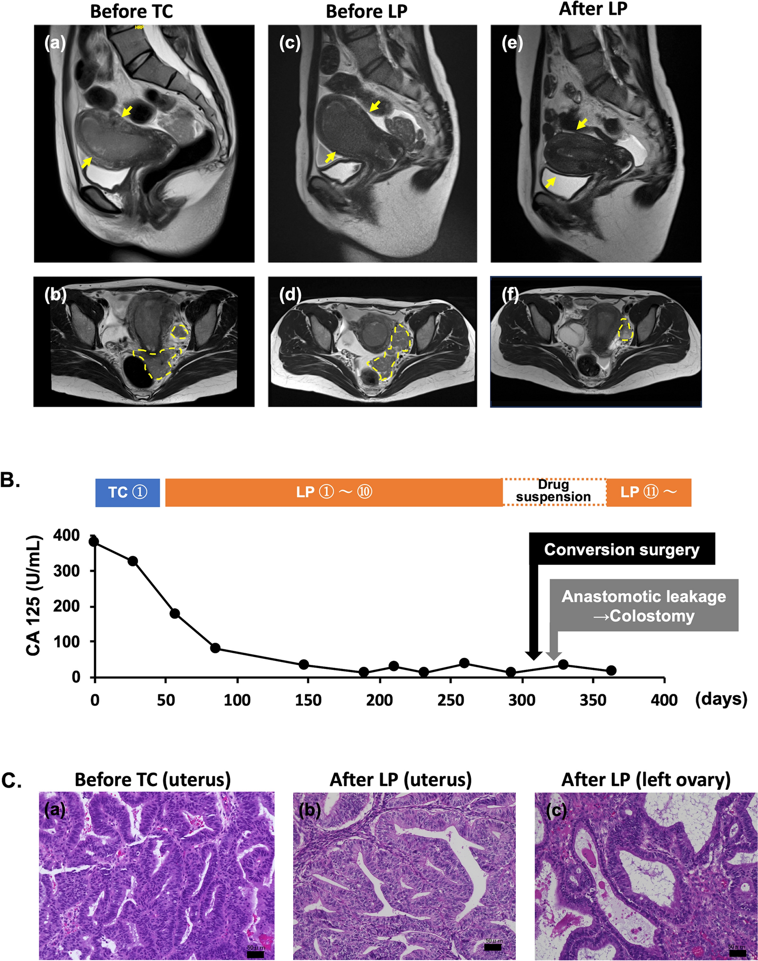 Colorectal anastomotic leakage after conversion surgery for advanced endometrial cancer treated with lenvatinib plus pembrolizumab: a case report