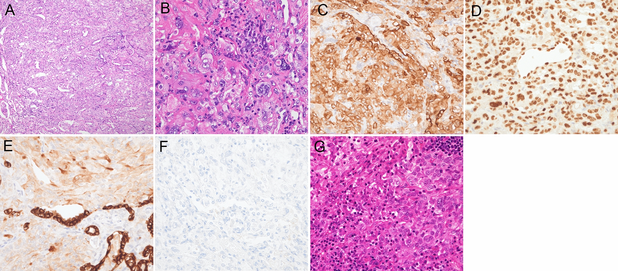 Successful immunotherapy with ipilimumab and nivolumab in a patient with pulmonary sclerosing pneumocytoma