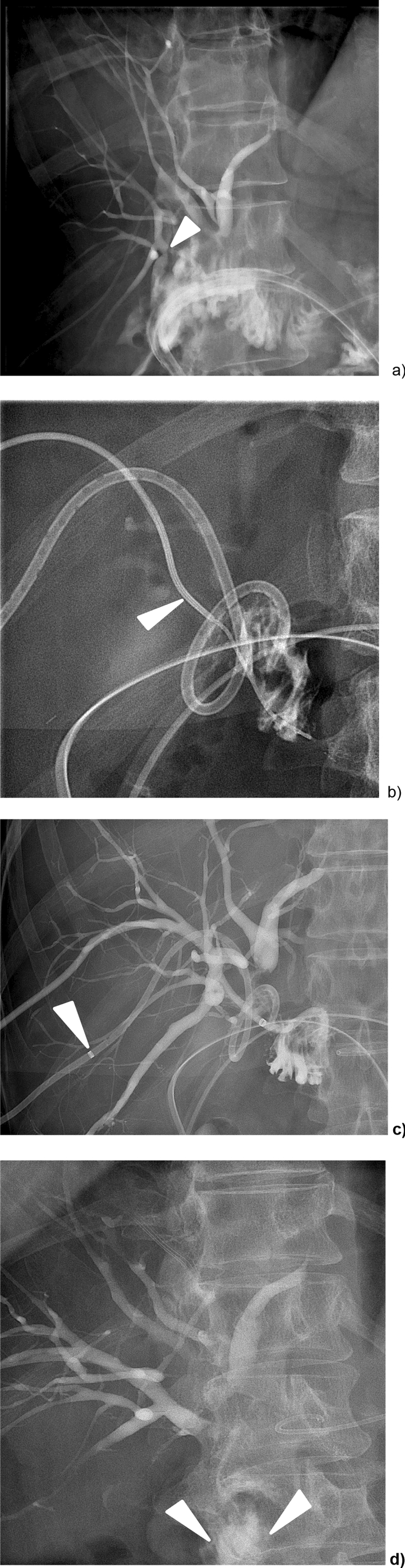 Percutaneous Biliary Neo-Anastomosis of Inadvertently Operatively Excluded Right Posterior Bile Ducts: A Durable and Highly Successful Procedure