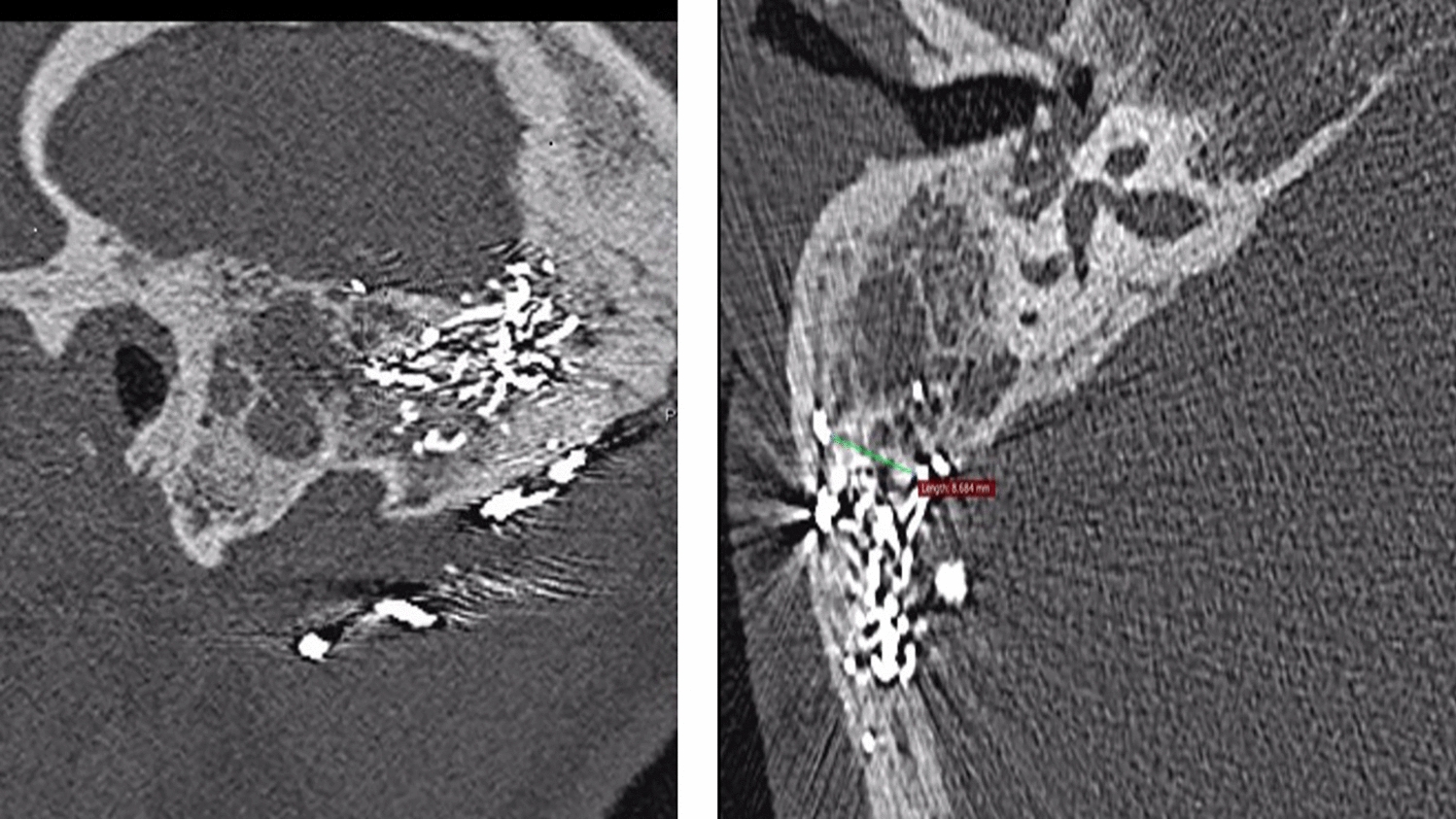 A Rare Case of Cholesterol Granuloma as a Complication of Onyx Embolization for Dural Arteriovenous Fistula