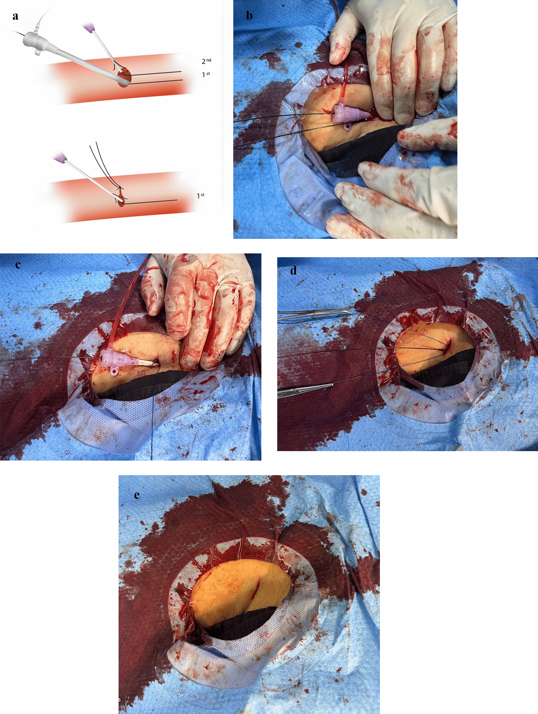 Post-closure Technique for Access Hemostasis During Emergency Endovascular Repair in Ruptured Abdominal Aortic Aneurysms: Technical Note on a Preliminary Experience