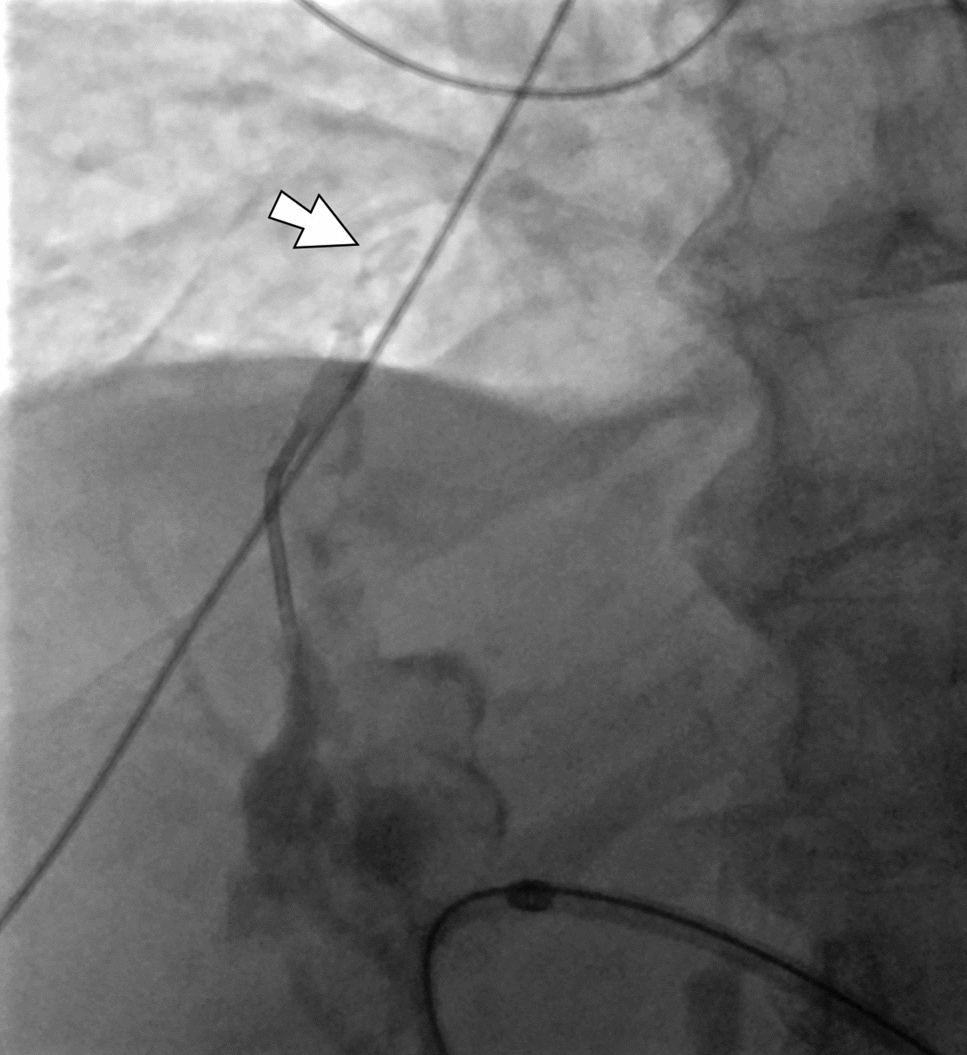 Novel Application of a Shear-Thinning Conformable Embolic Gel for Occlusion of a Bronchobiliary Fistula