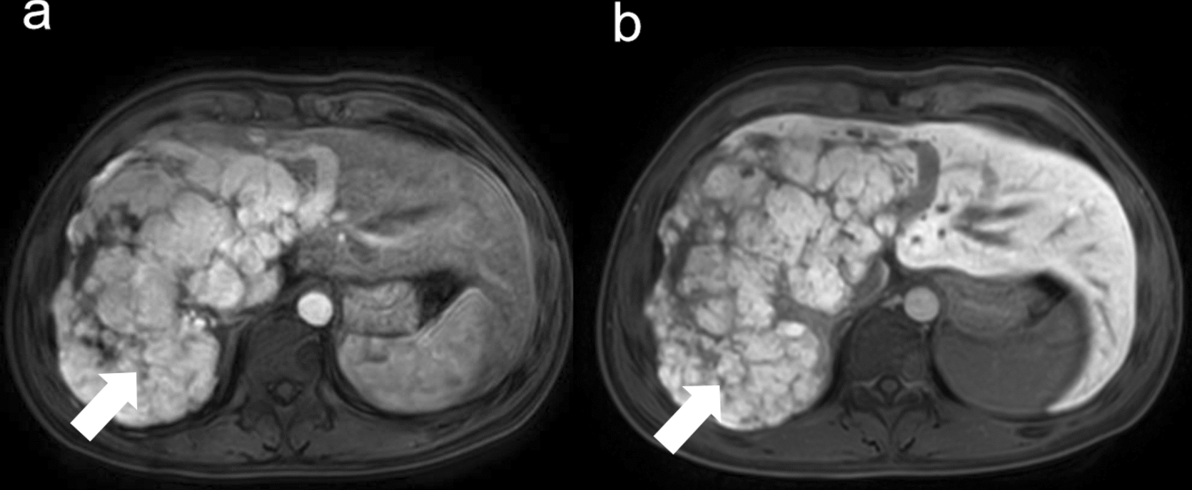 Transarterial Radioembolization with Yttrium-90 Resin Microspheres for Huge Focal Nodular Hyperplasia