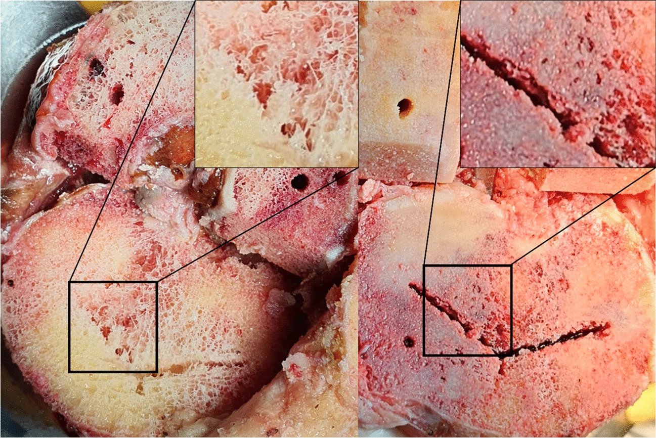 Evidence-based joint statement position of perioperative bone optimization in the arthroplasty candidate, from FEMECOT, AMMOM, ACOMM, SCCOT, SECOT, SEFRAOS, SEIOMM