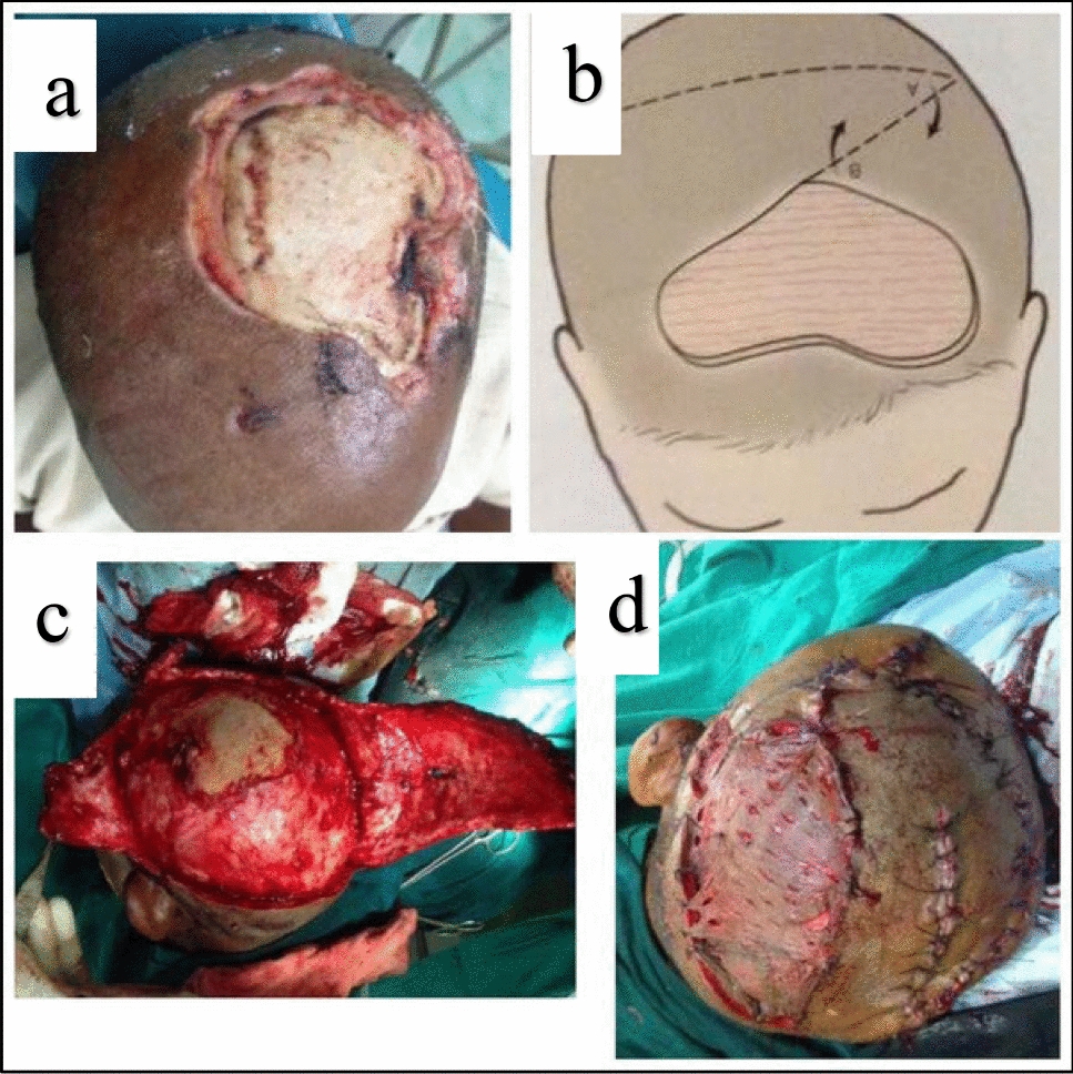 Bear Mauling Injuries in Maxillofacial Region: A Review of 30 victims from Eastern India