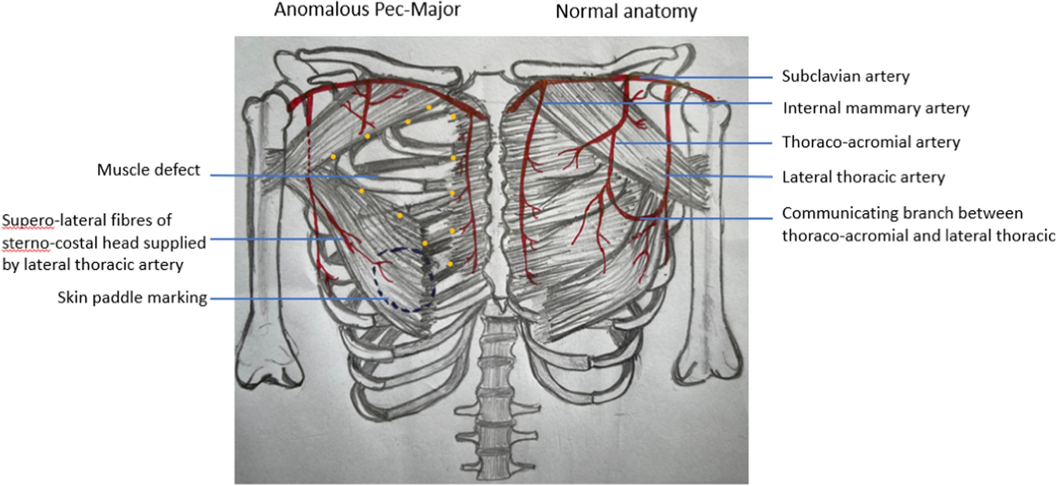 Case Report: Anomalous Pectoralis Major Muscle Identified During PMMC Flap Harvesting for Reconstruction in Head and Neck Region