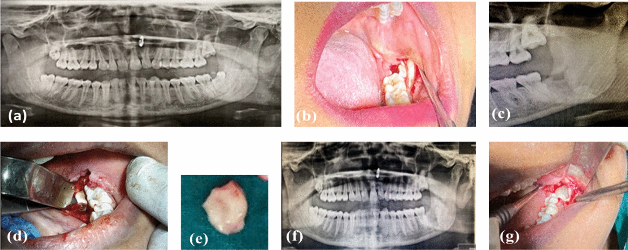 A Pragmatic Approach to the Management of Inadvertent Displacement of Wisdom Tooth into the Submandibular Space: Assessment of Risks, Literature Review, and Management Algorithm