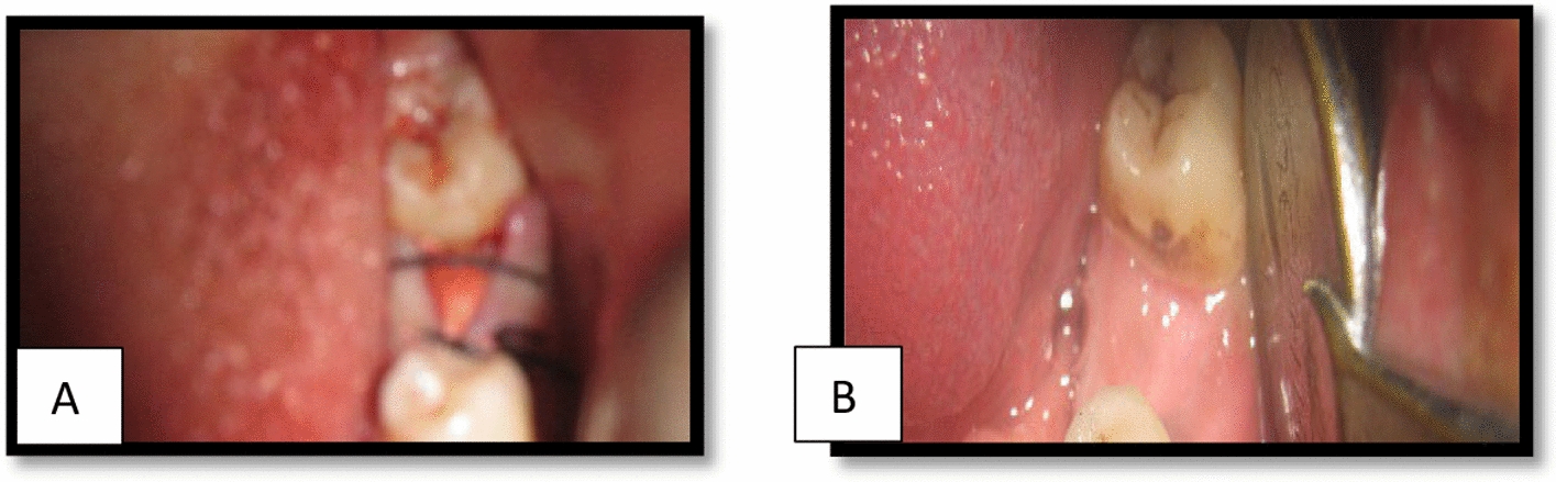 Guided Bone Regeneration (GBR) Using a Collagen Membrane Barrier Technique Along With Full Thickness Buccal Mucoperiosteal Flap For the Preservation of the Alveolar Ridge Following Tooth Extraction