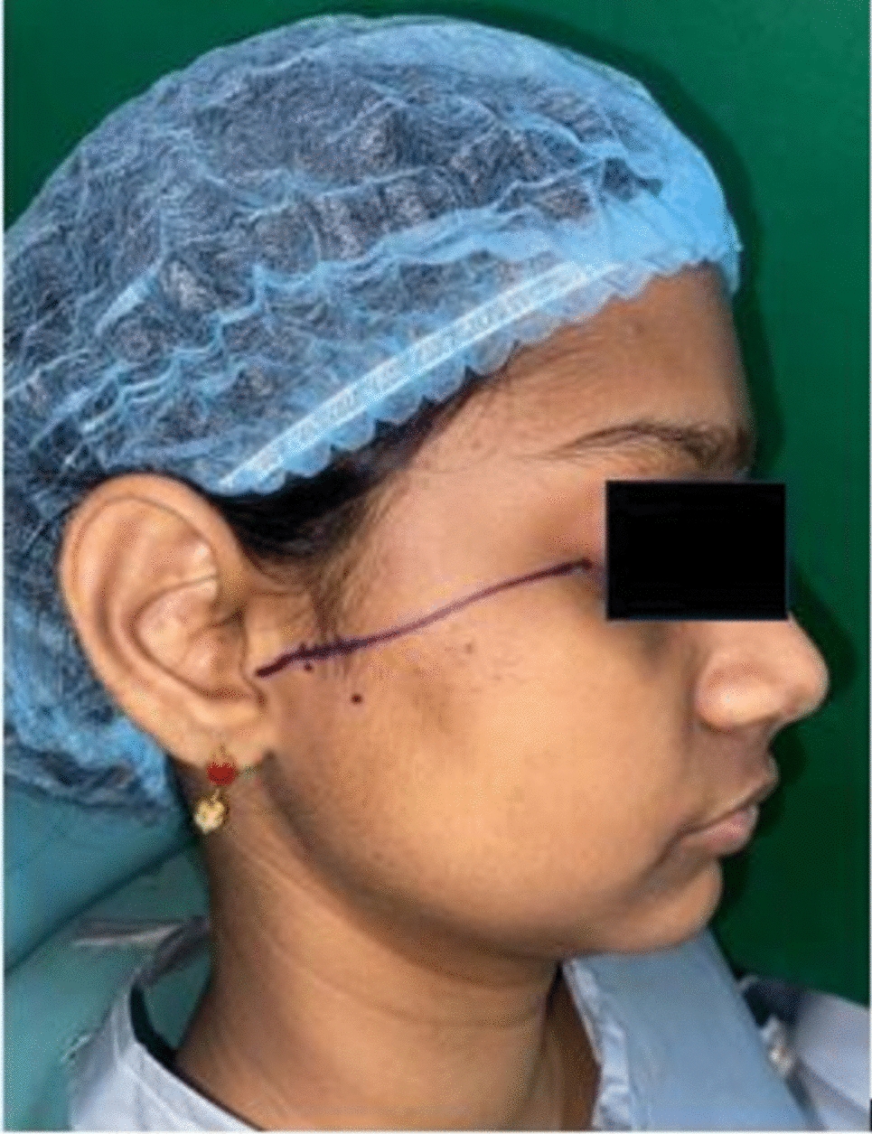 Study Between Soft and Hard Splints After Arthrocentesis in TMD Patients: Randomized Clinical Trial