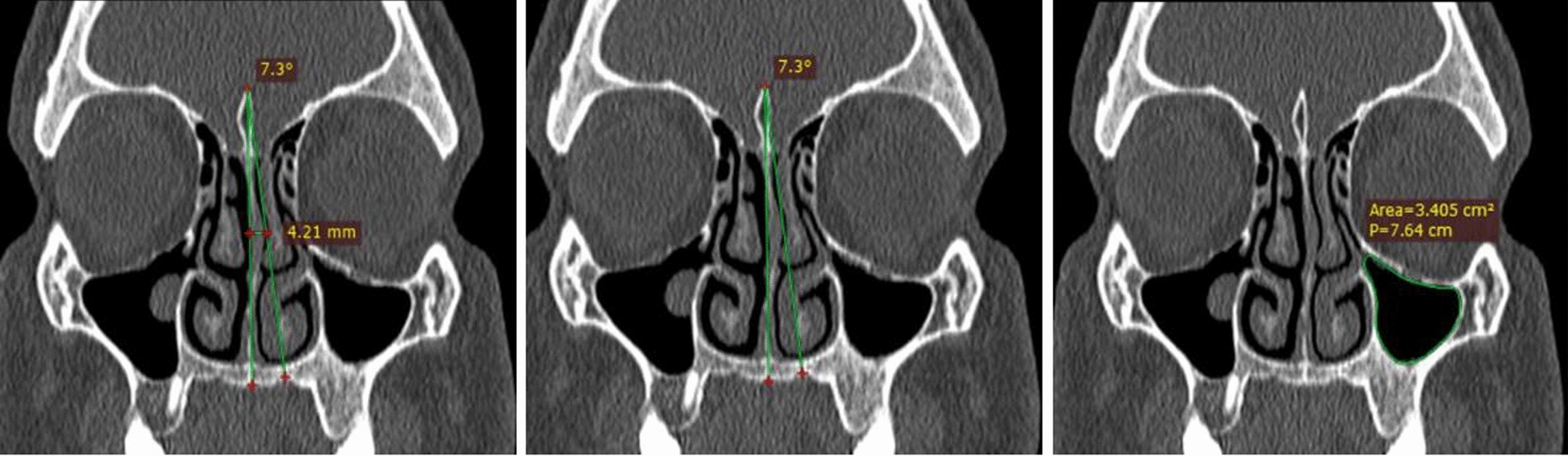 A Cross-sectional CT Investigation on Nasal Septal Deviation and its Association with Sinusitis