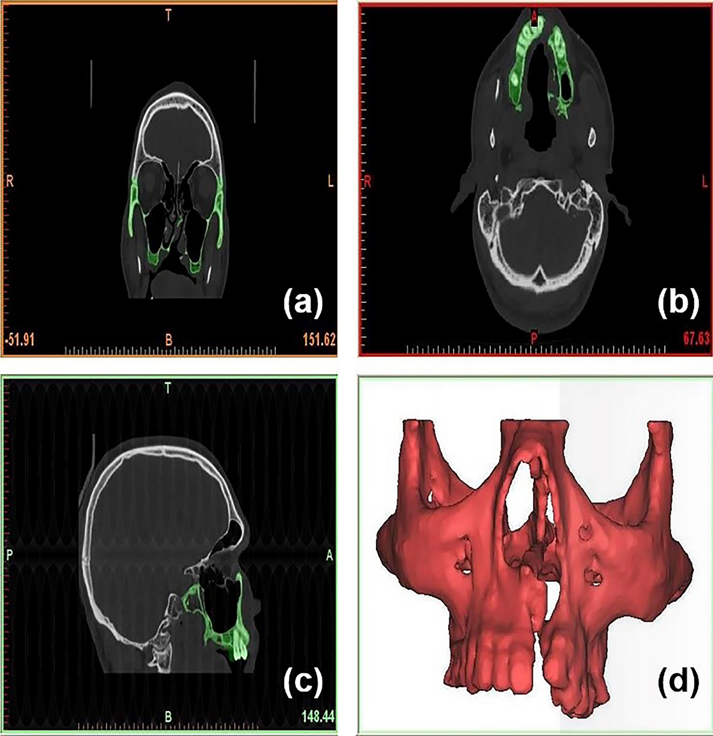 Evaluation of Stress in the Maxillary Complex of a Unilateral Cleft Lip and Palate on Simulated Occlusal Loading Using Finite Element Analysis