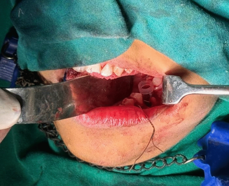Up-Cycling Unleashed: Modified Sterile Needle Cap with Luer Lock Plug for Irrigation