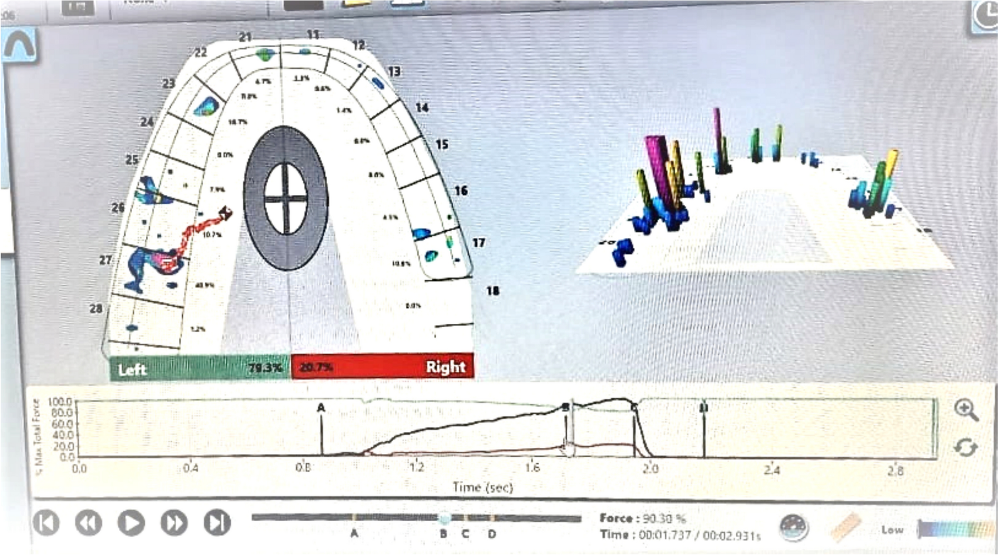 Assessment of Relative Bite Force Following Bi-Jaw Orthognathic Surgeries Using T-Scan