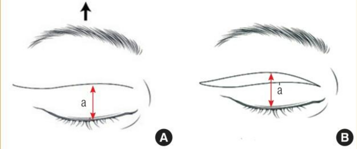Upper Blepharoplasty in Dermatochalasis: A Retrospective Study of Our Cases