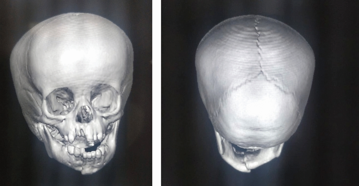 Management of Pediatric Mandibular Fractures: A Narrative Review and Retrospective Analytical Study of 15 Years