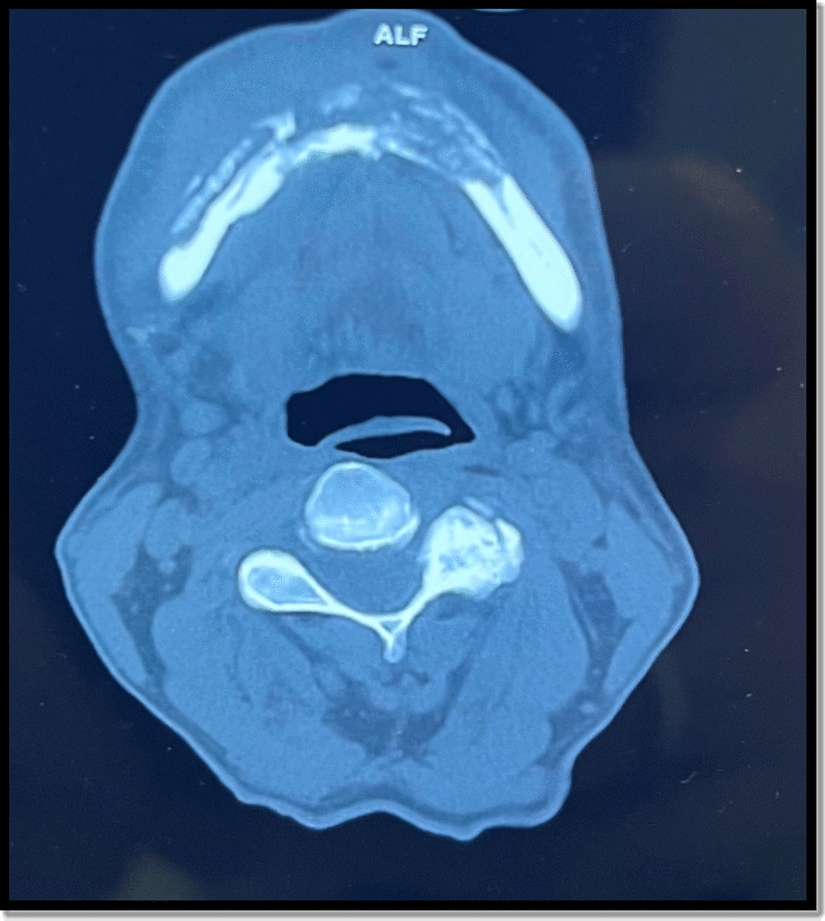 Mandibular Squamous Cell Carcinoma Mimicking Chronic Osteomyelitis: Diagnostic Dilemma
