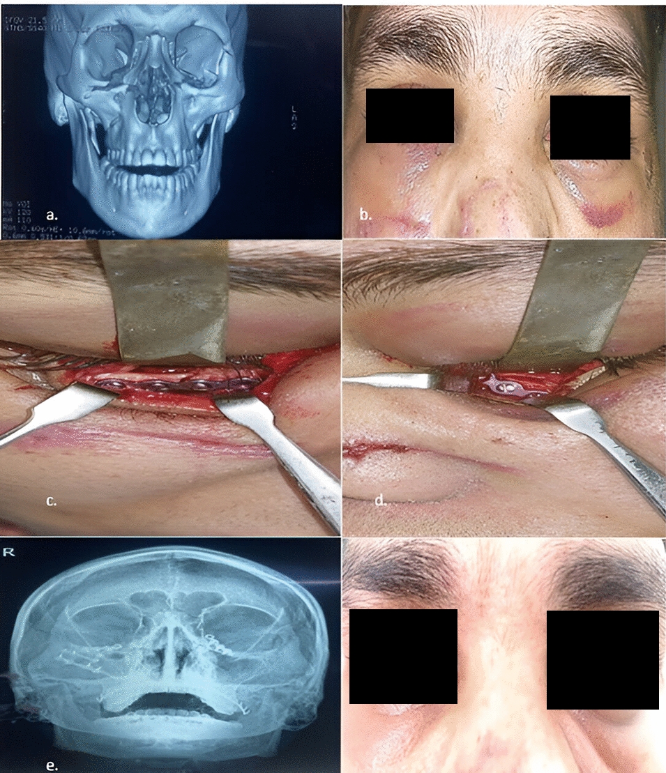 The Transconjunctival Incision: A Boon for Scarless Surgery of the Orbital Region—A Case Series