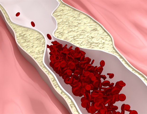 Researchers discover key signaling pathway involved in atherosclerotic plaques
