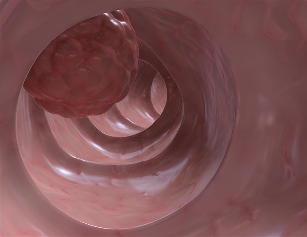 Study reveals ferulic acid's potential in preventing colon cancer