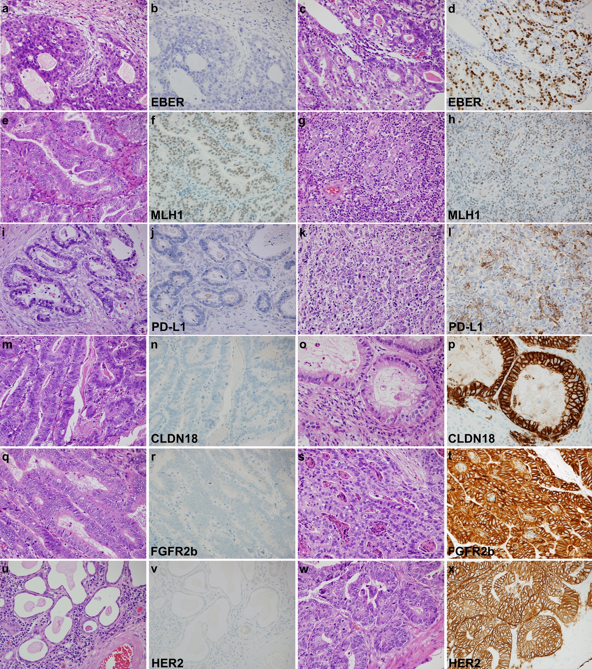 Expression of therapy target molecules in esophagogastric junction and Barrett’s adenocarcinoma