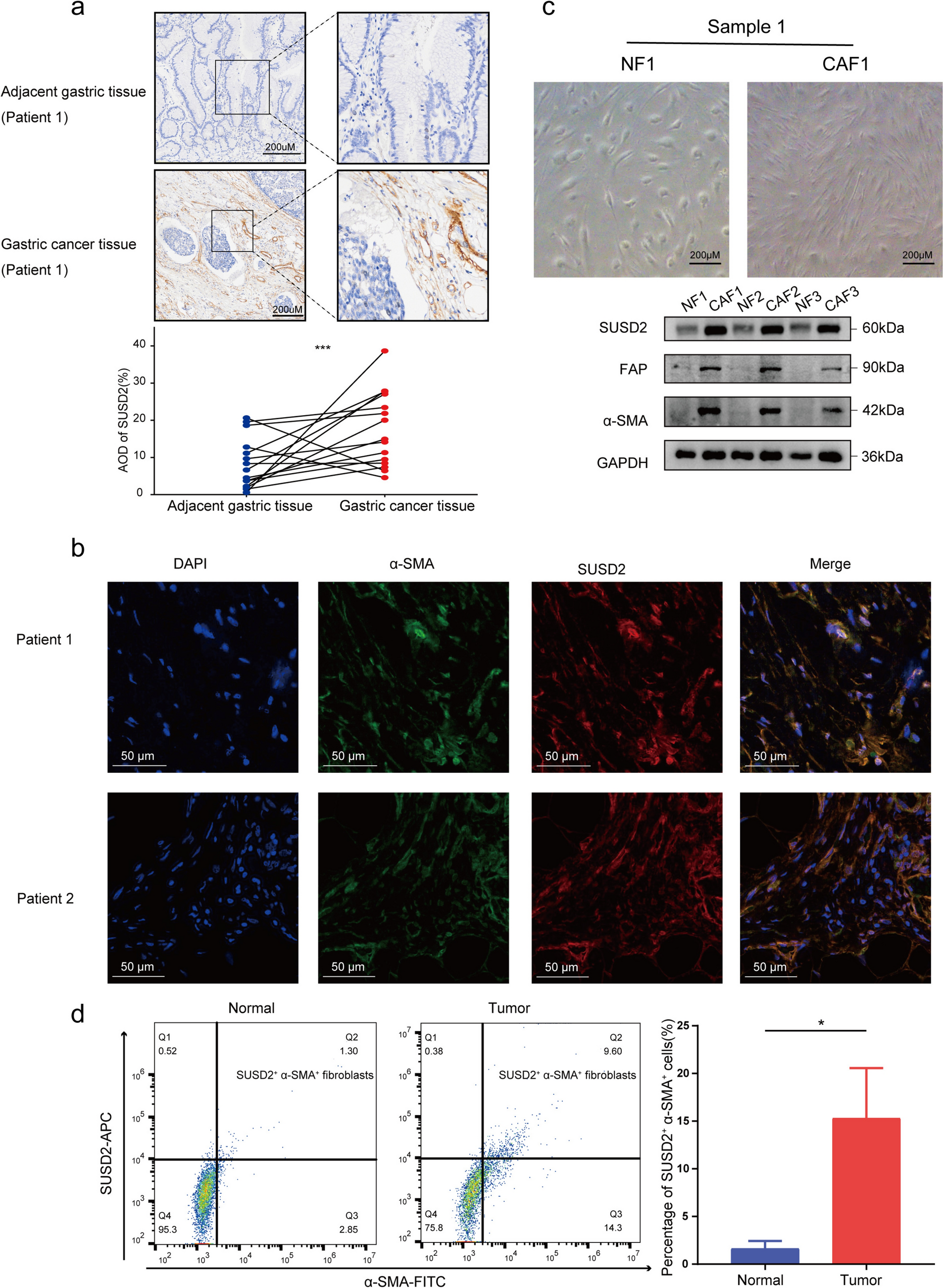 SUSD2+ cancer-associated fibroblasts in gastric cancer mediate the effect of immunosuppression and predict overall survival and the effectiveness of neoadjuvant immunotherapy