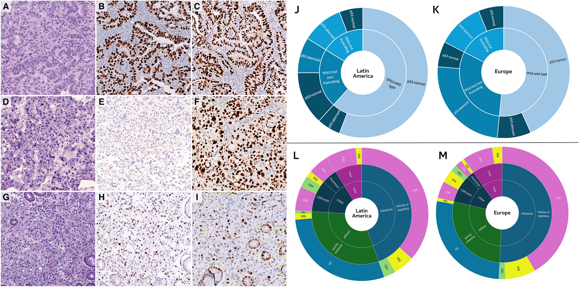 Comprehensive histopathological analysis of gastric cancer in European and Latin America populations reveals differences in PDL1, HER2, p53 and MUC6 expression