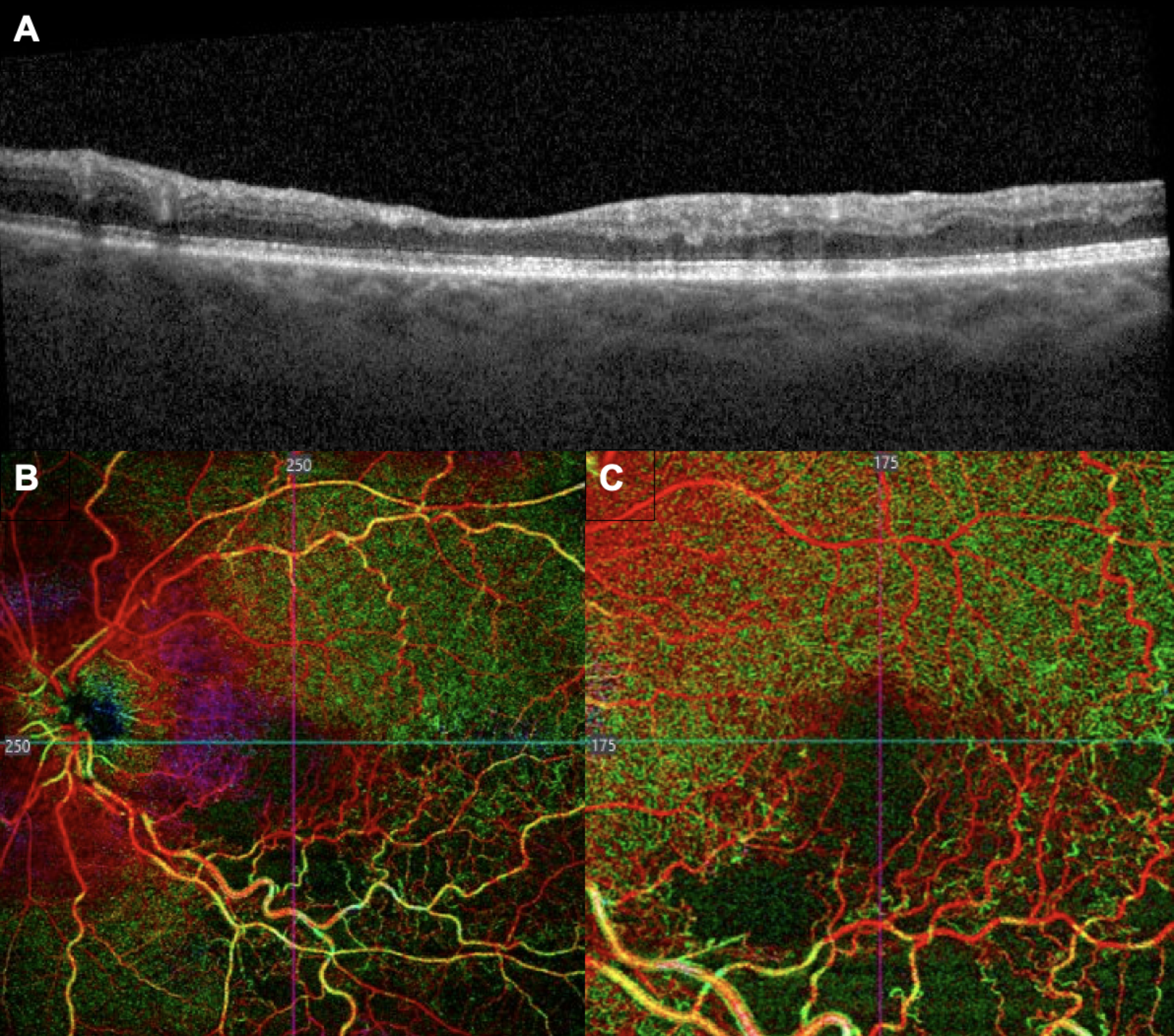 The Use of Retinal Imaging Including Fundoscopy, OCT, and OCTA for Cardiovascular Risk Stratification and the Detection of Subclinical Atherosclerosis