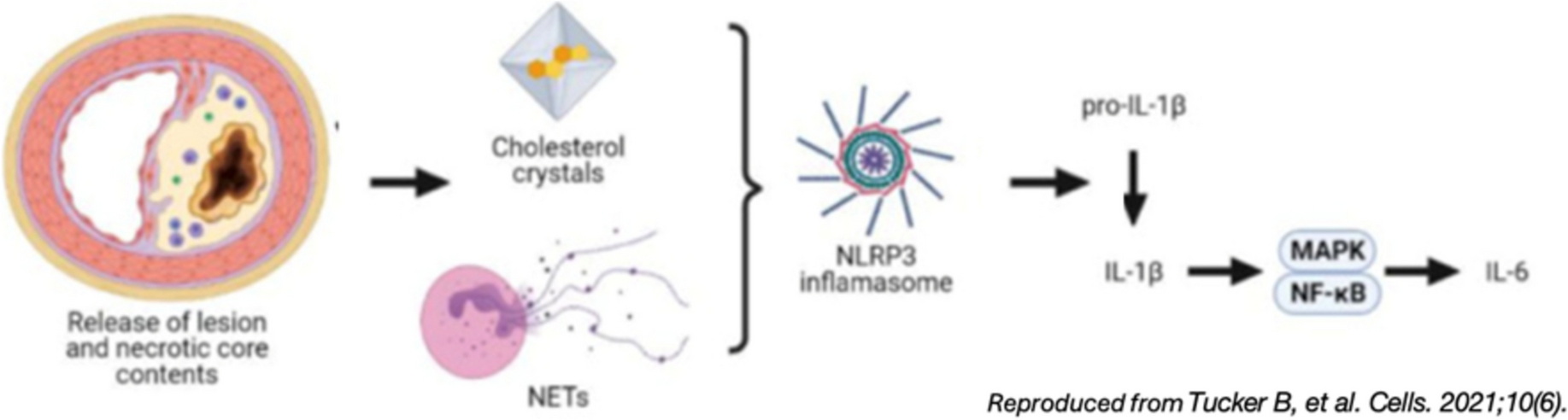 Inflammation in the Peri-ACS Period: Ready for Prime Time?
