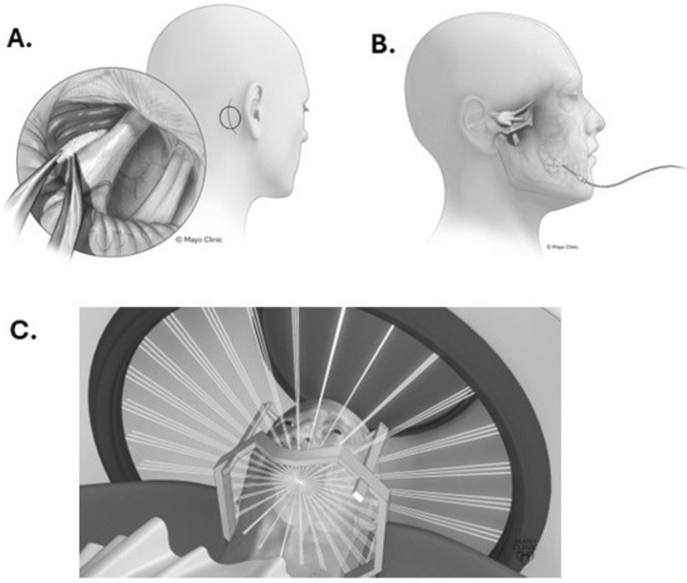 Pathophysiology and Management of Refractory Trigeminal Neuralgia