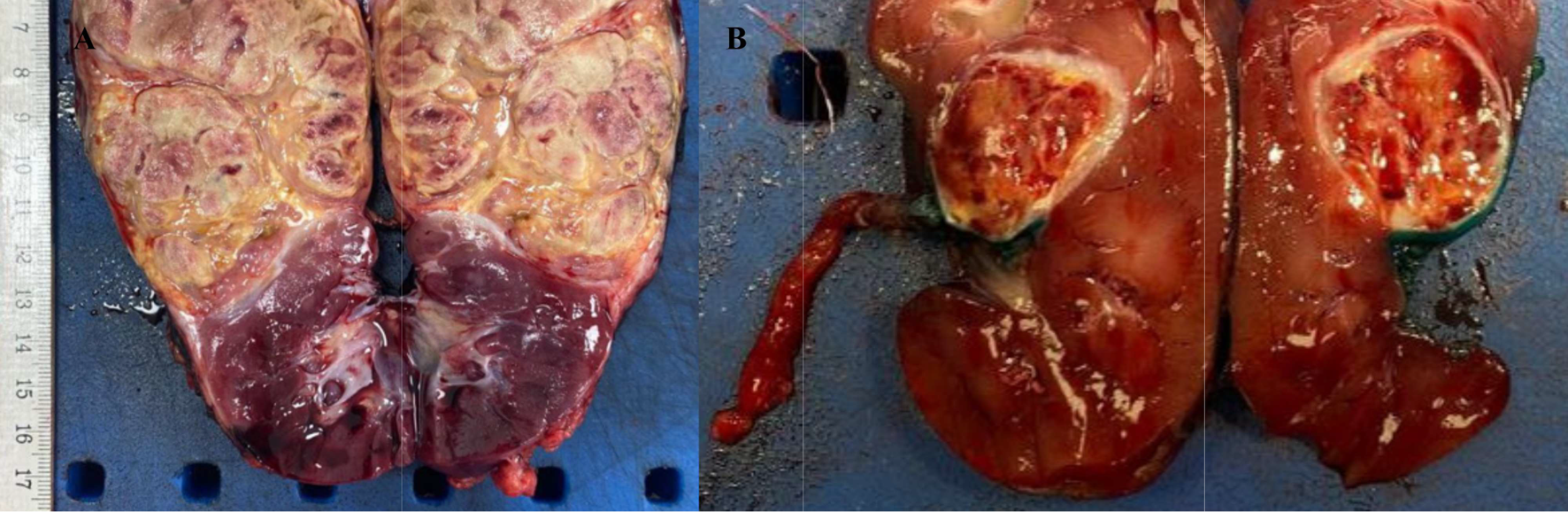 Paediatric Renal Tumors: A State-of-the-Art Review