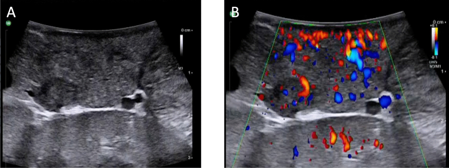 Novel Surgical Initiatives in Gastroenteropancreatic Neuroendocrine Tumours