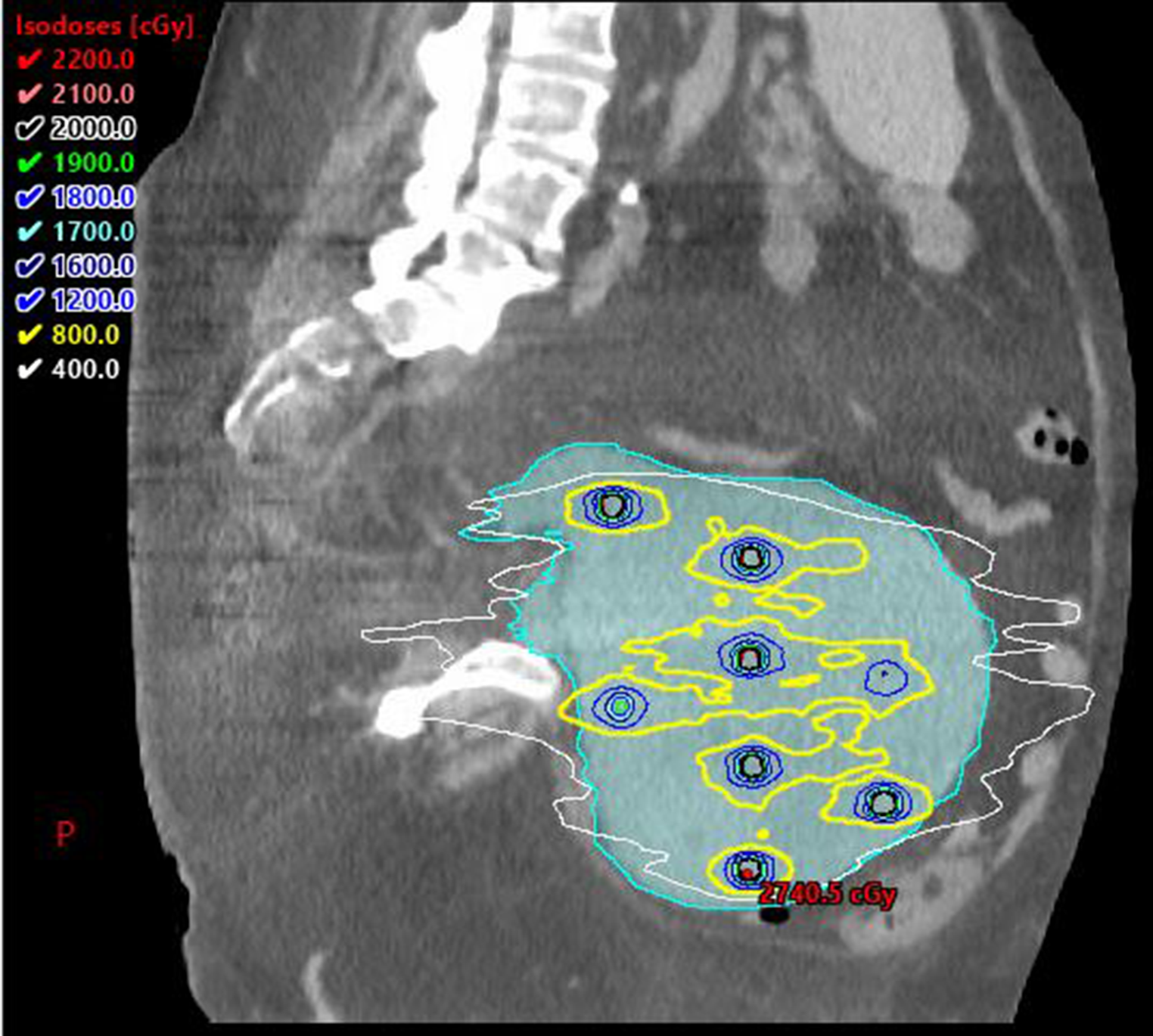 Advances in Radiation Oncology in Soft Tissue Sarcoma