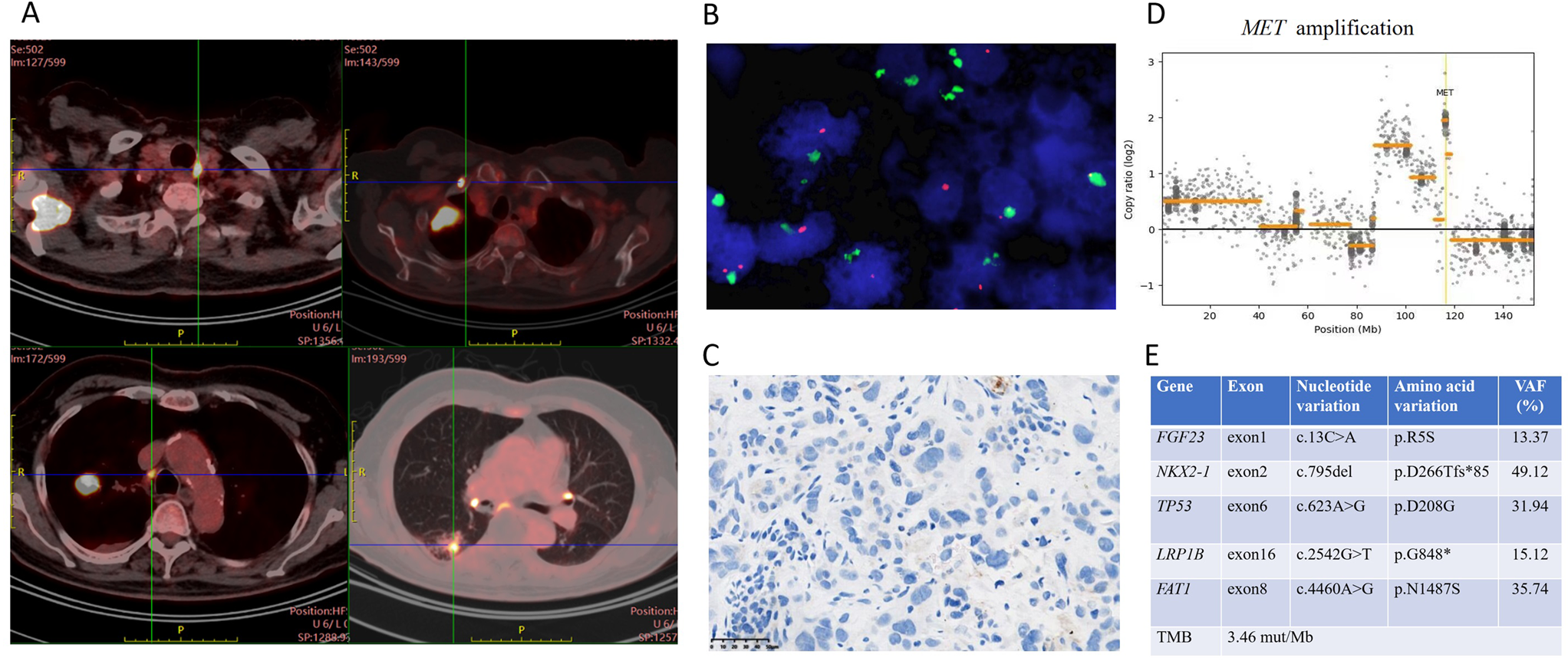 -amplified NSCLC treated with savolitinib achieved remarkable tumor regression: a case report and review of literature