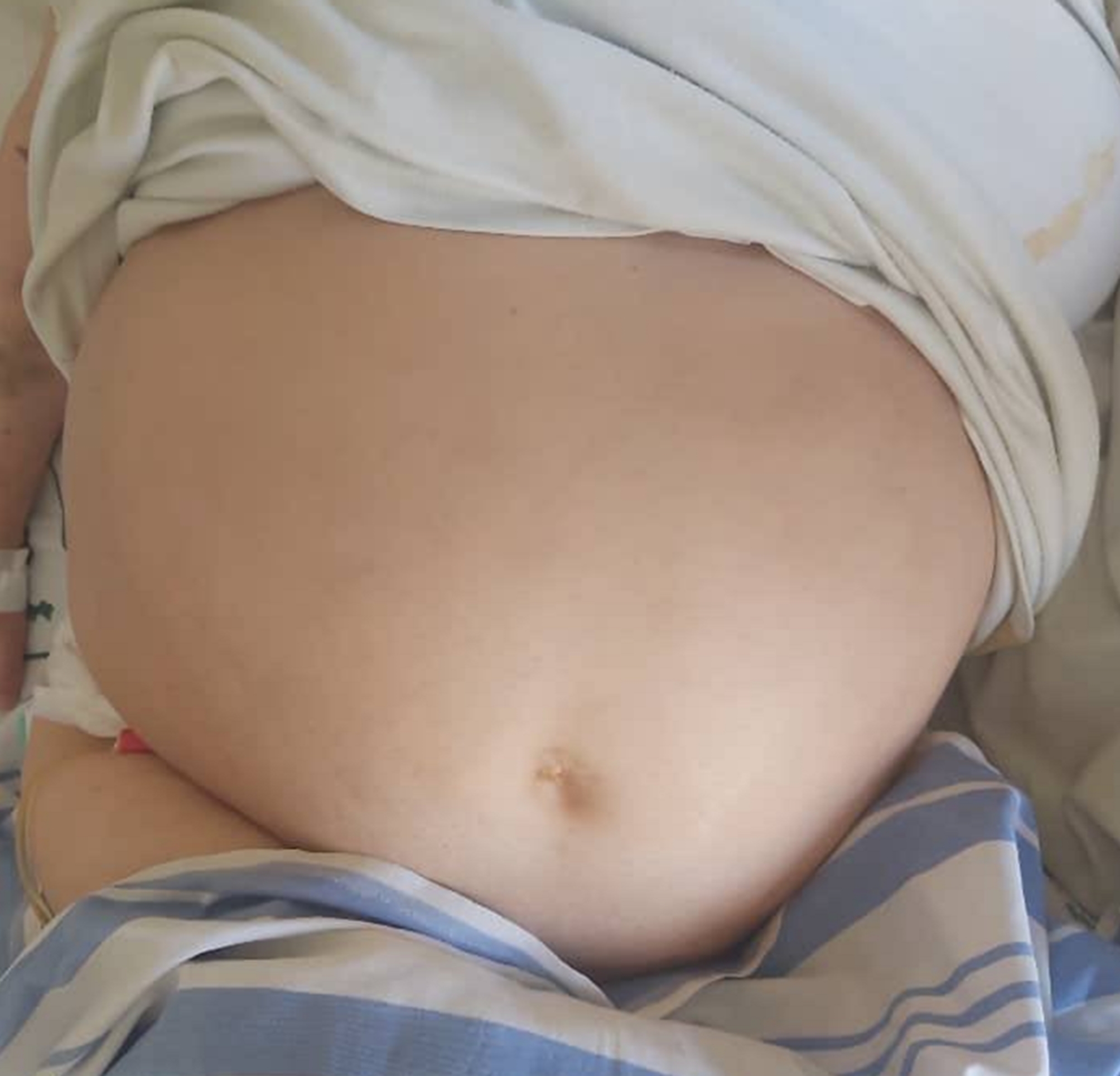 An Ogilvie’s syndrome: a rare case of large bowel pseudo-obstruction