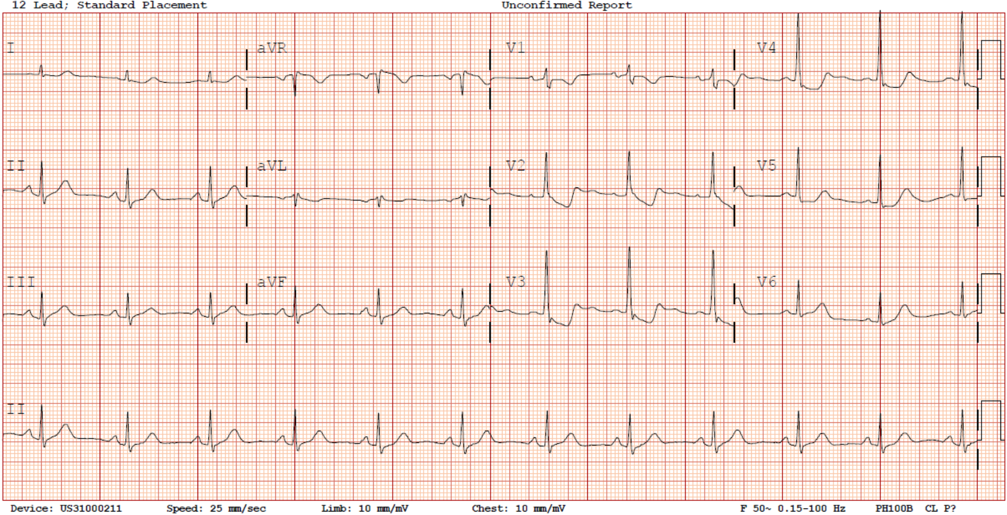 Posterior STEMI presenting as painless, isolated left arm numbness and weakness: a case report