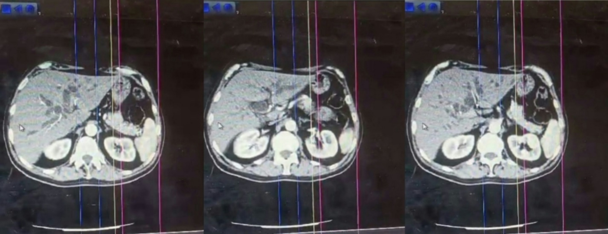 Challenges in diagnosing and treating distal common bile duct adenocarcinoma: A case report with literature insights